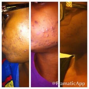 Photo "Can I Really Get Rid of Stretch Marks with Natural Treatments?"